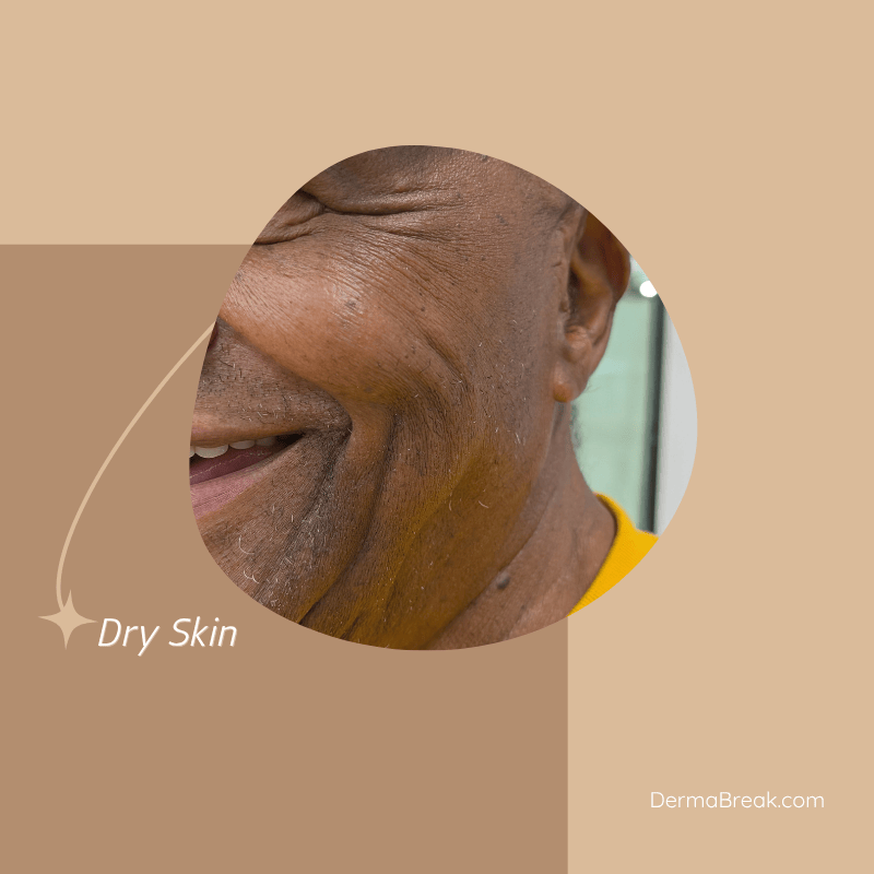 The Science of Age-Related Xerosis